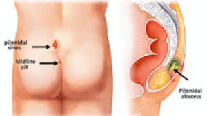 Can Pilonidal Sinus Cause Death? 