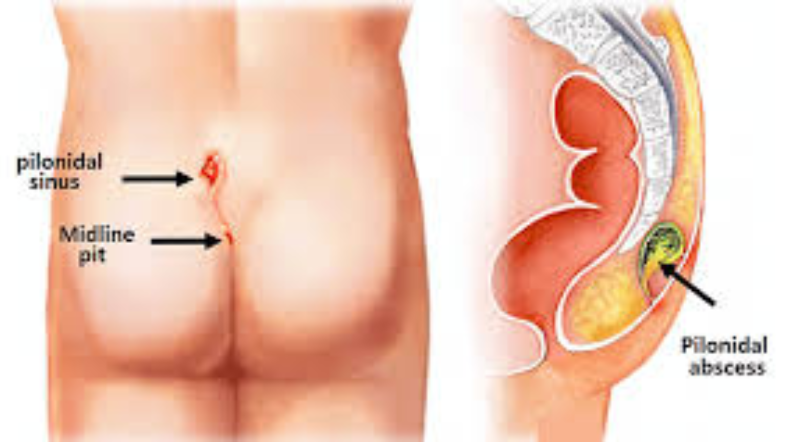 Can Pilonidal Sinus Cause Death?